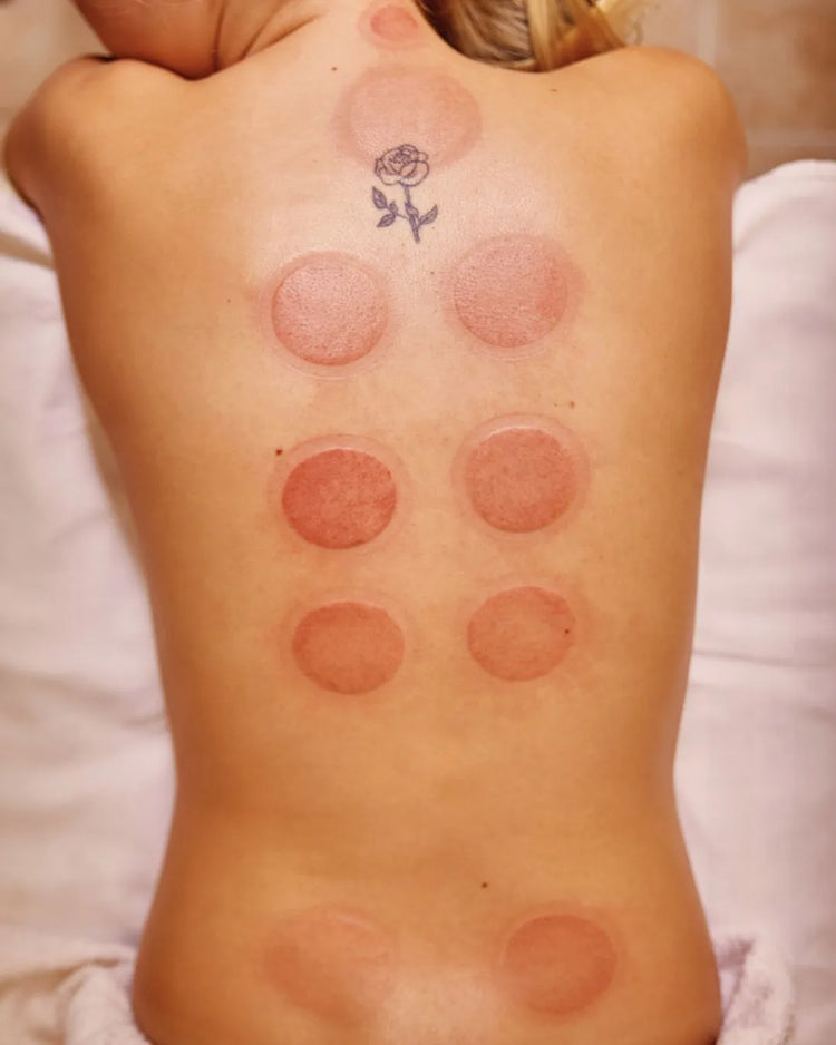 Les sucions sur le dos d'une femme après l'application du cupping